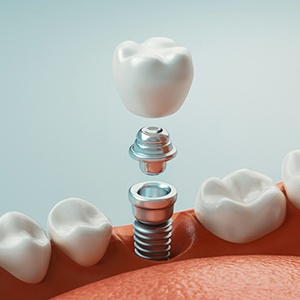 A 3D illustration of dental implant parts