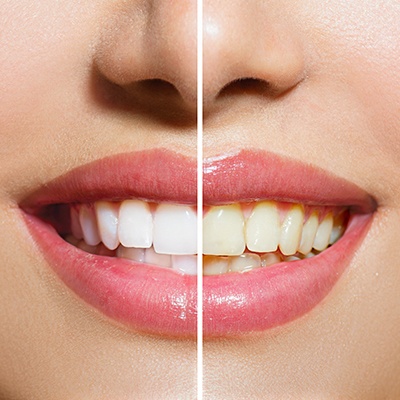 before and after tooth discoloration