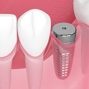 Digital illustration of dental implant in the jawbone