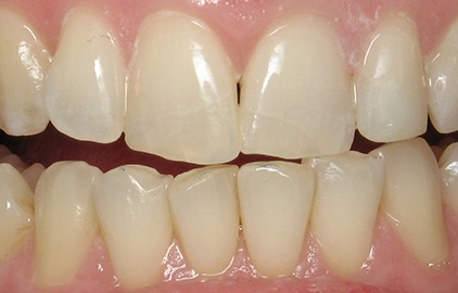 patient #2 cosmetic bonding after