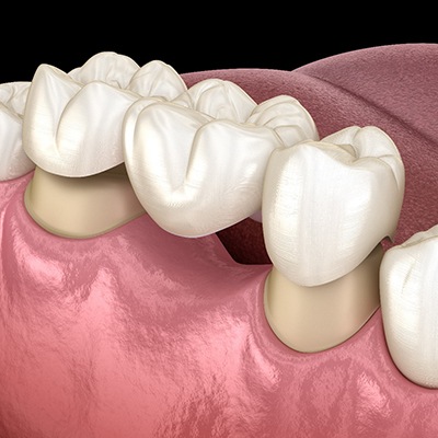 Render of a dental bridge in Haverhill, MA for the lower arch of teeth