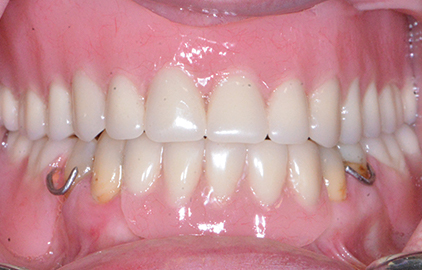 patient #1 dentures after
