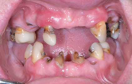 patient #1 dentures before