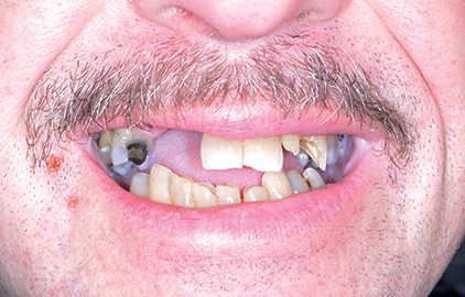 patient #2 dentures before