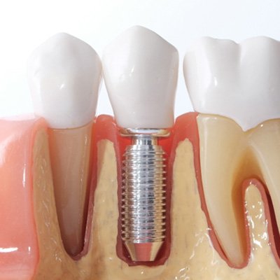 Close-up of a model of natural teeth and a dental implant in Haverhill, MA