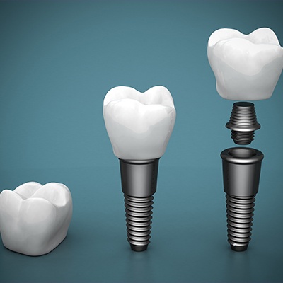 three piece implant