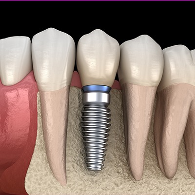 implant in bone