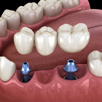 multiple implant