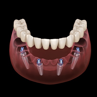 implant dentures