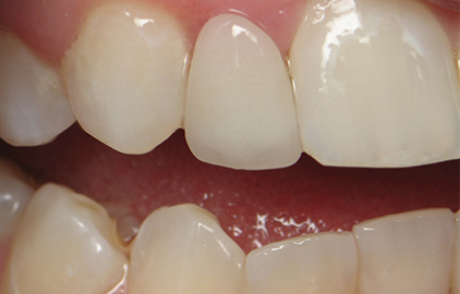 patient #1 dental implants after