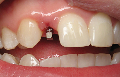 patient #1 dental implants before