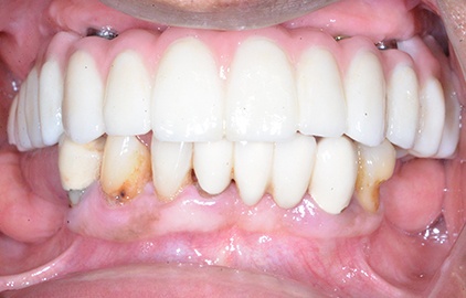 patient #2 dental implants after