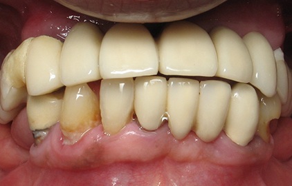 patient #2 dental implants before