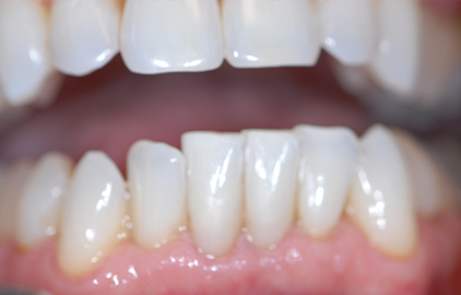 patient #2 black triangle removal after