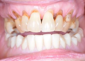 teeth with receded gums