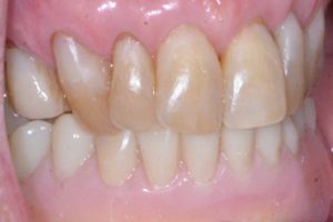several healthy teeth