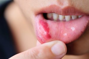 canker sore on bottom lip