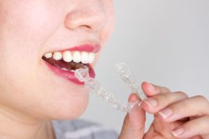 woman inserting clear tray in mouth