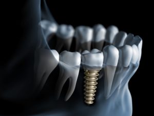 Digital illustration of dental implants