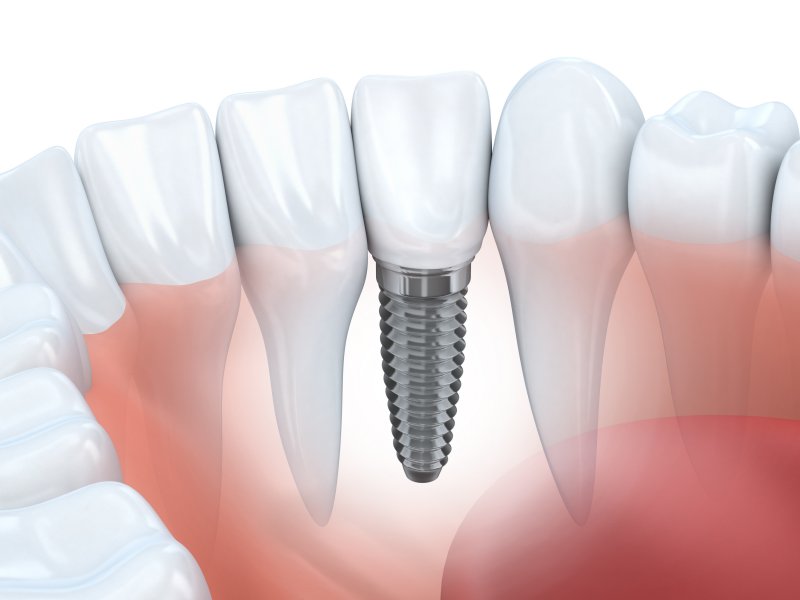 3D illustration of a dental implant
